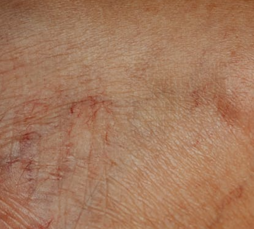 Pigmentation