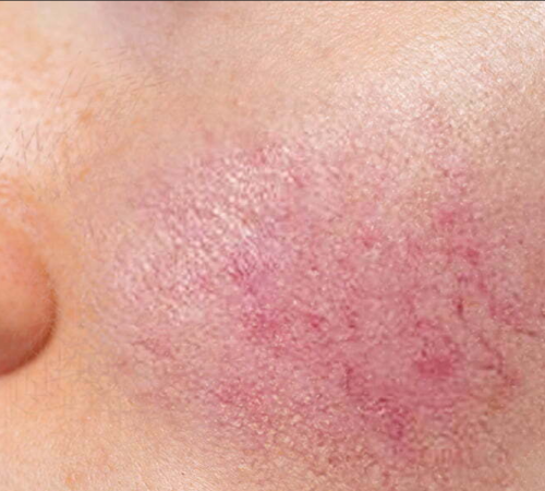 Rosacea 1
