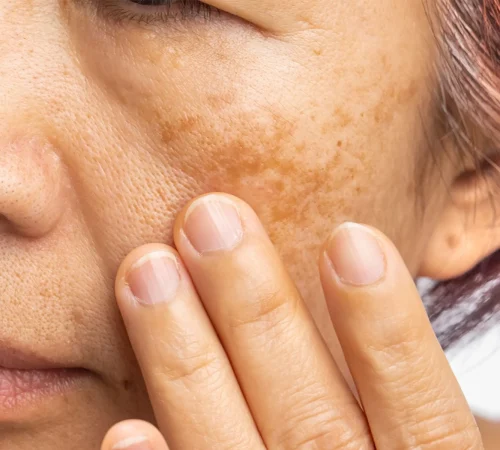 melasma2