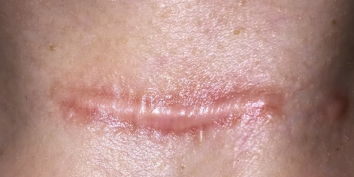 neck scar